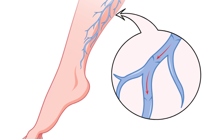 Vene Varicose: Rimedi, Trattamenti e Prevenzione Efficace