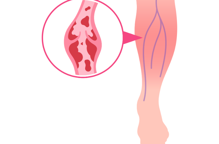 Crema per Far Sparire le Vene Varicose: Soluzioni Disponibili in Farmacia